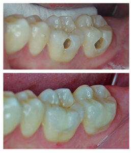 Réparation Et Restauration Des Dents Par Le Composite Dentaire