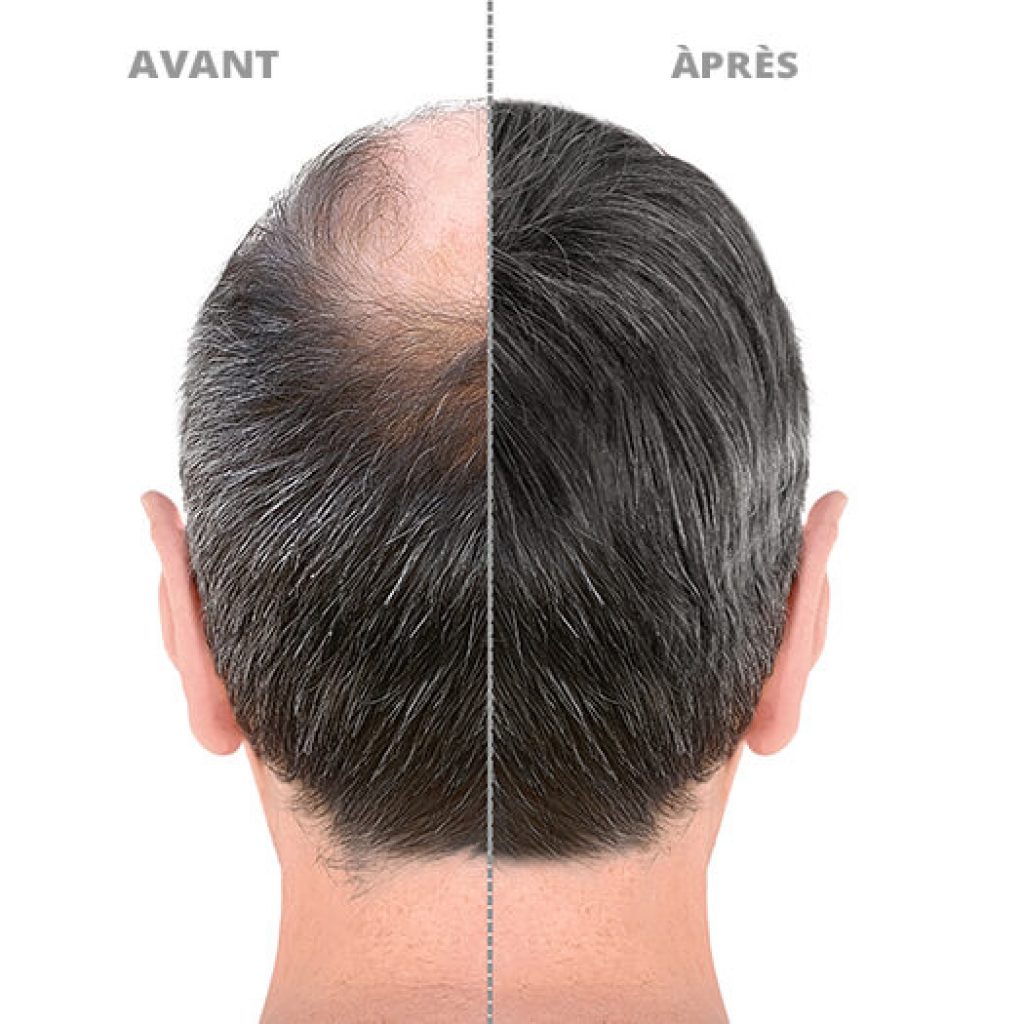 greffe-cheveux-avant-apres