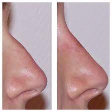 resultat-rhinoplastie-fils-tenseurs