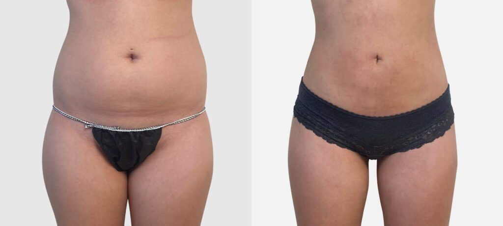 resultat-liposuccion-ventre-femme