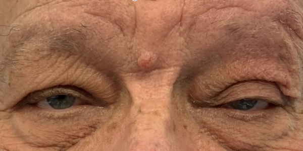 ptosis des paupières supérieures