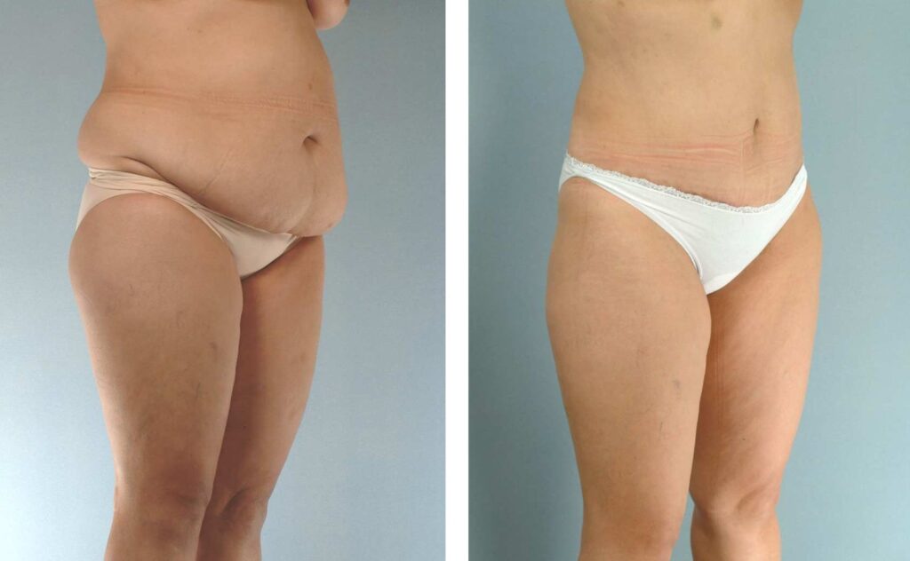 abdominoplastie apres grossesses tunisie prix pas cher